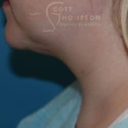 After Image: Submental Liposuction by Dr. Thompson – 906 - left-side