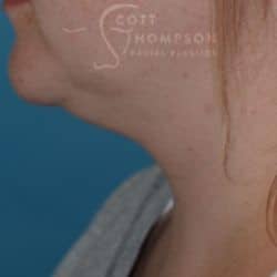 Before Image: Submental Liposuction by Dr. Thompson – 906 - left-side