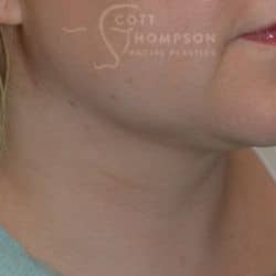 After Image: Submental Liposuction by Dr. Thompson – 906 - right-front-oblique