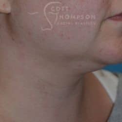 Before Image: Submental Liposuction by Dr. Thompson – 906 - right-front-oblique