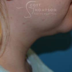 After Image: Submental Liposuction by Dr. Thompson – 906 - right-side