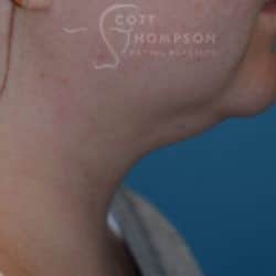 Before Image: Submental Liposuction by Dr. Thompson – 906 - right-side