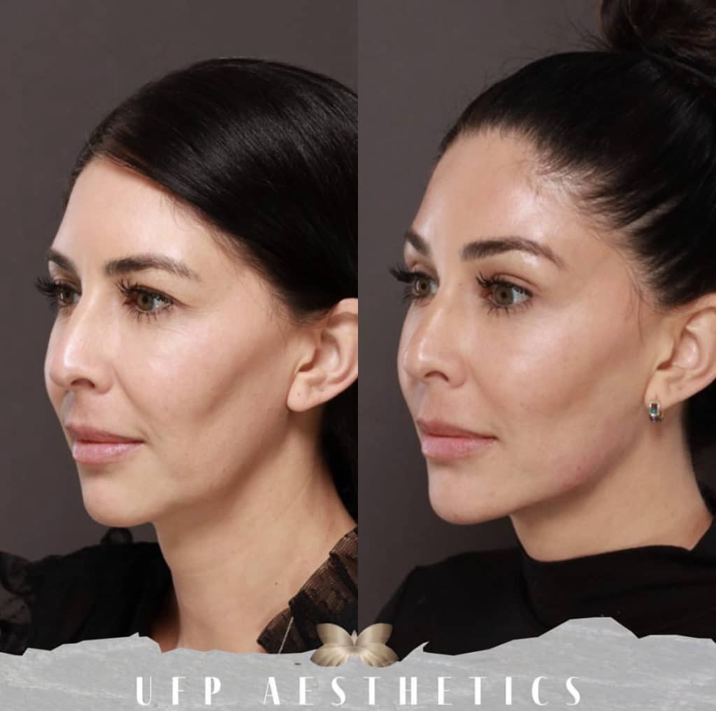 Can Dermal Fillers Get Rid Of My Jowls? Utah Facial Plastics