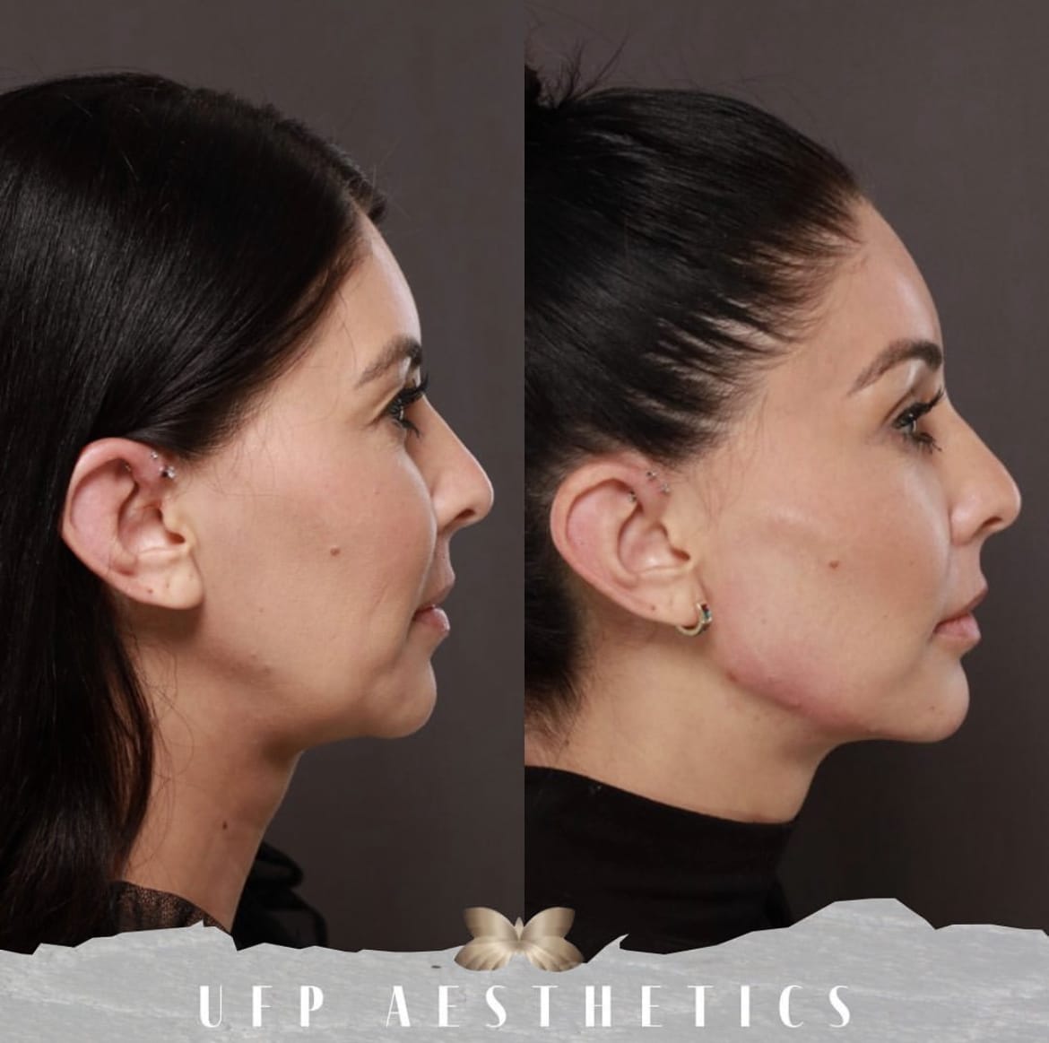 Can Dermal Fillers Get Rid Of My Jowls Utah Facial Plastics understanding-and-treating-the-appearance-of-jowls-reviva-labs