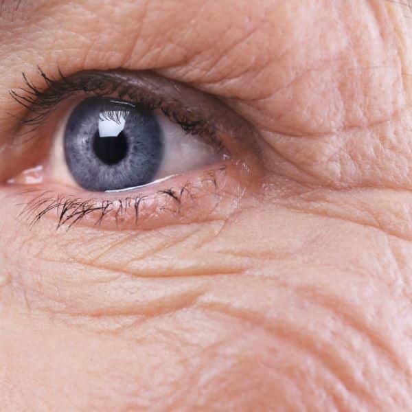 under eye wrinkles botox