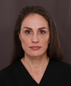 Facelift by Dr. Manning