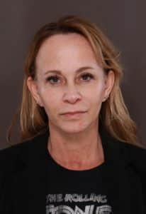 Macslift, Upper & Lower Blepharoplasty by Dr. Henstrom