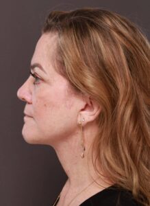 Facelift, Lower Blepharoplasty, Periorbital Fat Grafting by Dr. Thompson