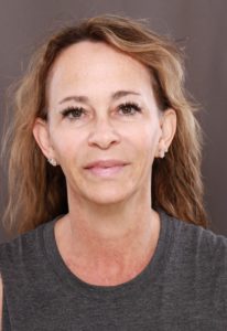 Macslift, Upper & Lower Blepharoplasty by Dr. Henstrom