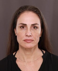 Facelift by Dr. Manning