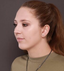 Chin Implant by Dr. Henstrom