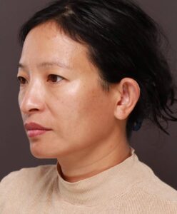 Otoplasty by Dr. Manning