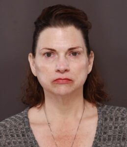 Facelift, Upper Blepharoplasty, Periorbital Fat Grafting by Dr. Thompson
