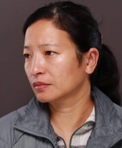 Otoplasty by Dr. Manning
