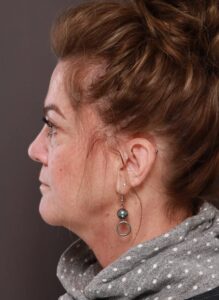 Facelift, Lower Blepharoplasty, Periorbital Fat Grafting by Dr. Thompson