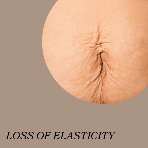 loss of elasticity