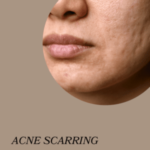 Halo Laser Treatment Draper UT