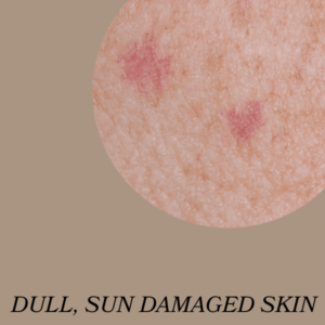 Halo Laser Treatment Salt Lake City UT