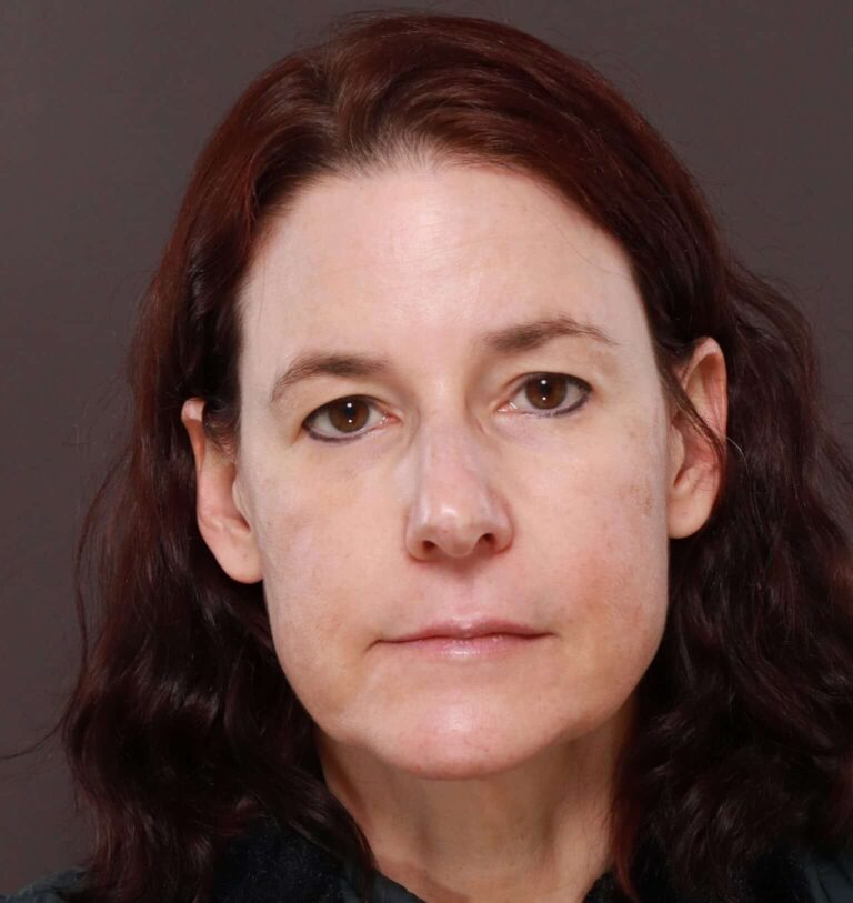 Before Image: Upper Blepharoplasty by Dr. Manning - front