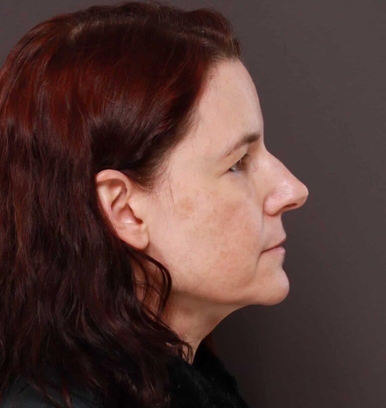 Before Image: Upper Blepharoplasty by Dr. Manning -