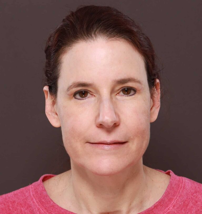 After Image: Upper Blepharoplasty by Dr. Manning - front