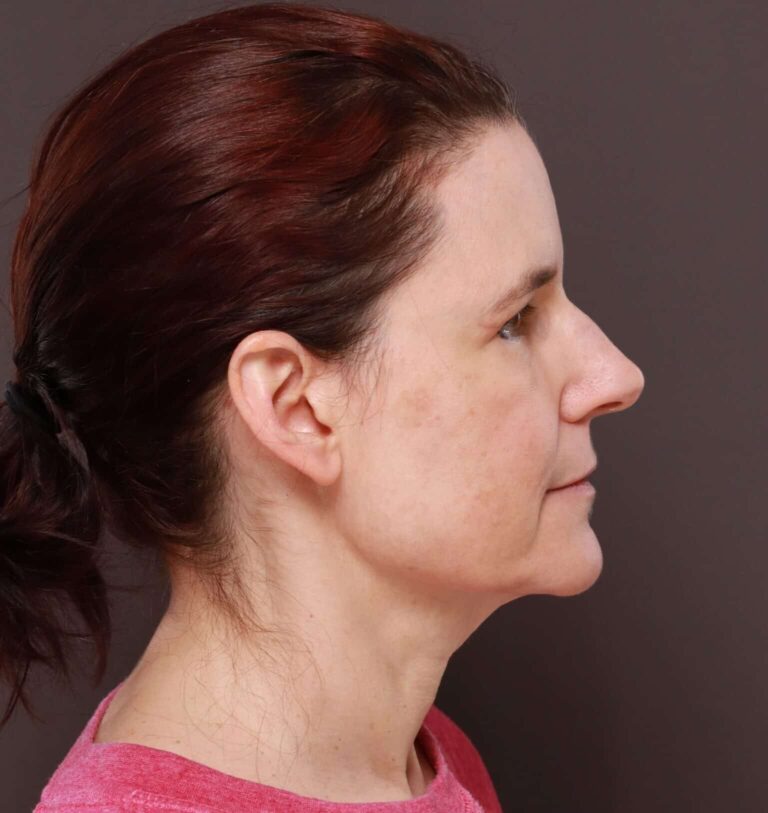 After Image: Upper Blepharoplasty by Dr. Manning -