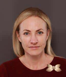 Facelift, Upper Blepharoplasty, Skin Pinch with Periorbital Fat Grafting by Dr. Thompson