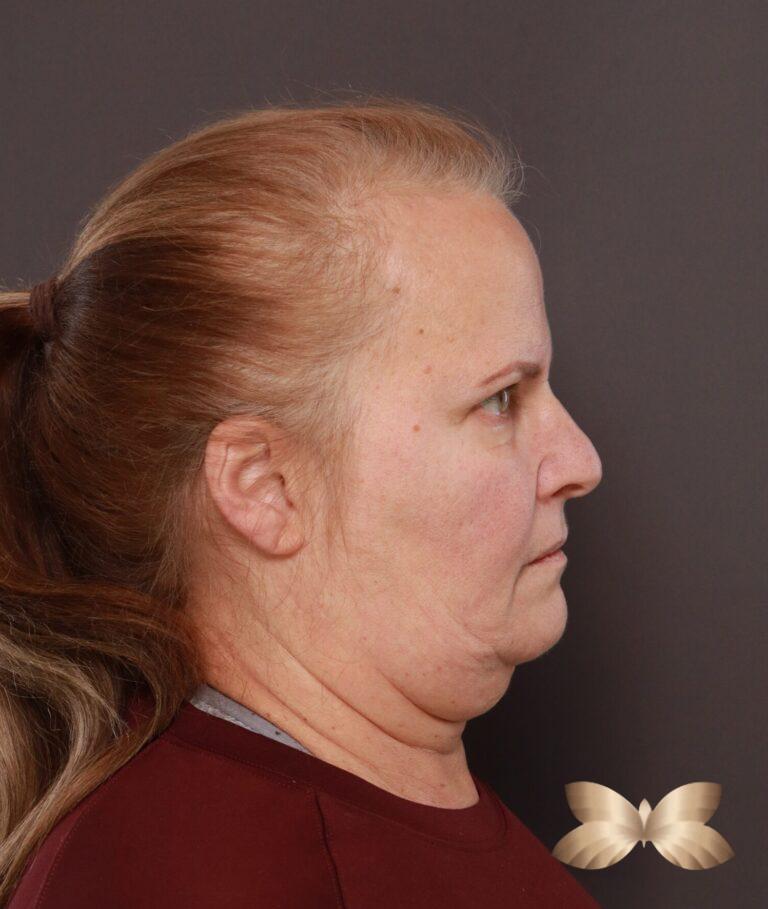 Before Image: Facelift, Lower Blepharoplasty with Periorbital Fat Grafting by Dr. Thompson -