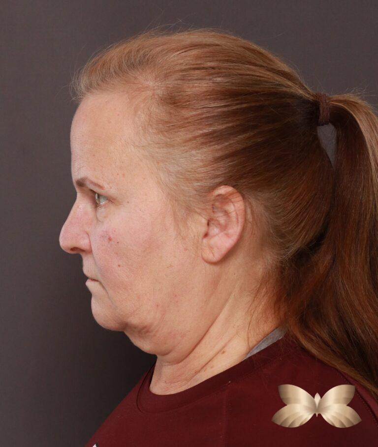 Before Image: Facelift, Lower Blepharoplasty with Periorbital Fat Grafting by Dr. Thompson - left-side