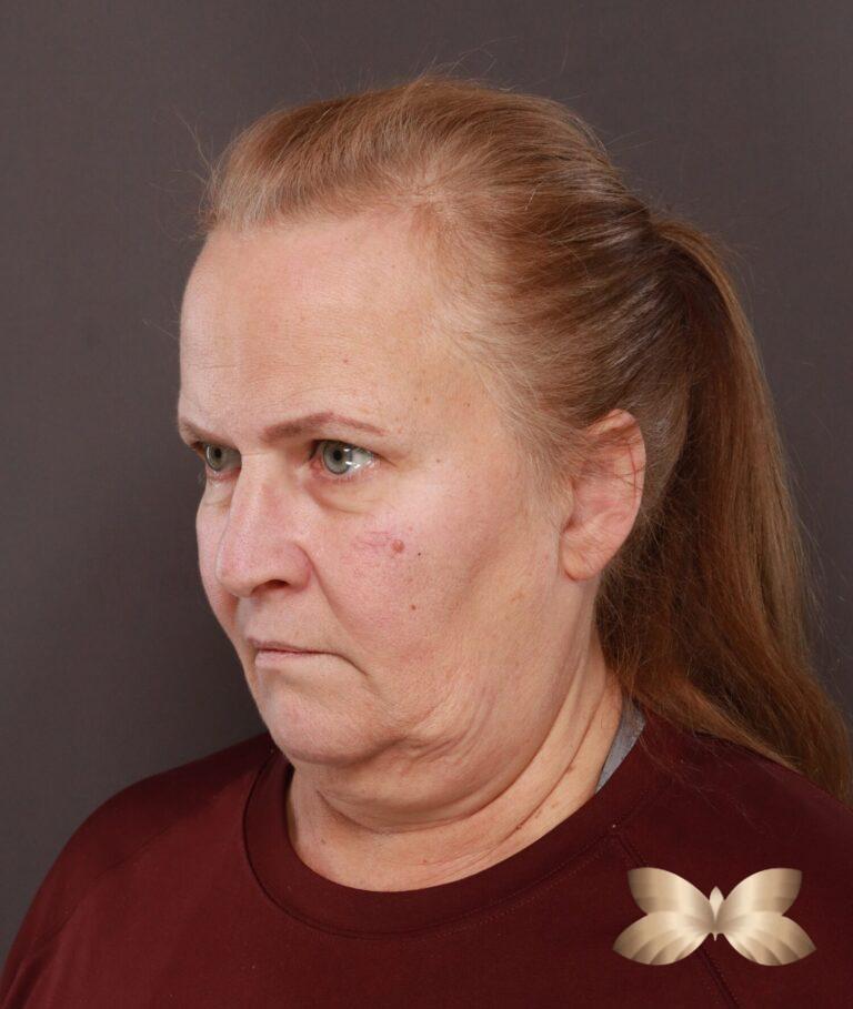 Before Image: Facelift, Lower Blepharoplasty with Periorbital Fat Grafting by Dr. Thompson - left-front-oblique