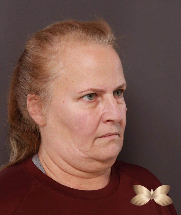 Before Image: Facelift, Lower Blepharoplasty with Periorbital Fat Grafting by Dr. Thompson - right-side