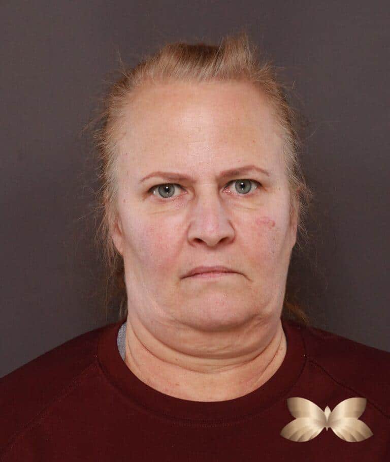 Before Image: Facelift, Lower Blepharoplasty with Periorbital Fat Grafting by Dr. Thompson - front