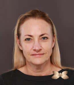 Facelift, Upper Blepharoplasty, Skin Pinch with Periorbital Fat Grafting by Dr. Thompson