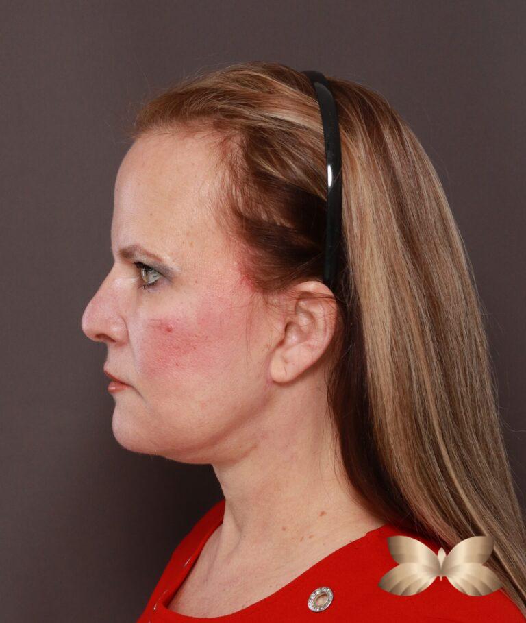 After Image: Facelift, Lower Blepharoplasty with Periorbital Fat Grafting by Dr. Thompson - left-side