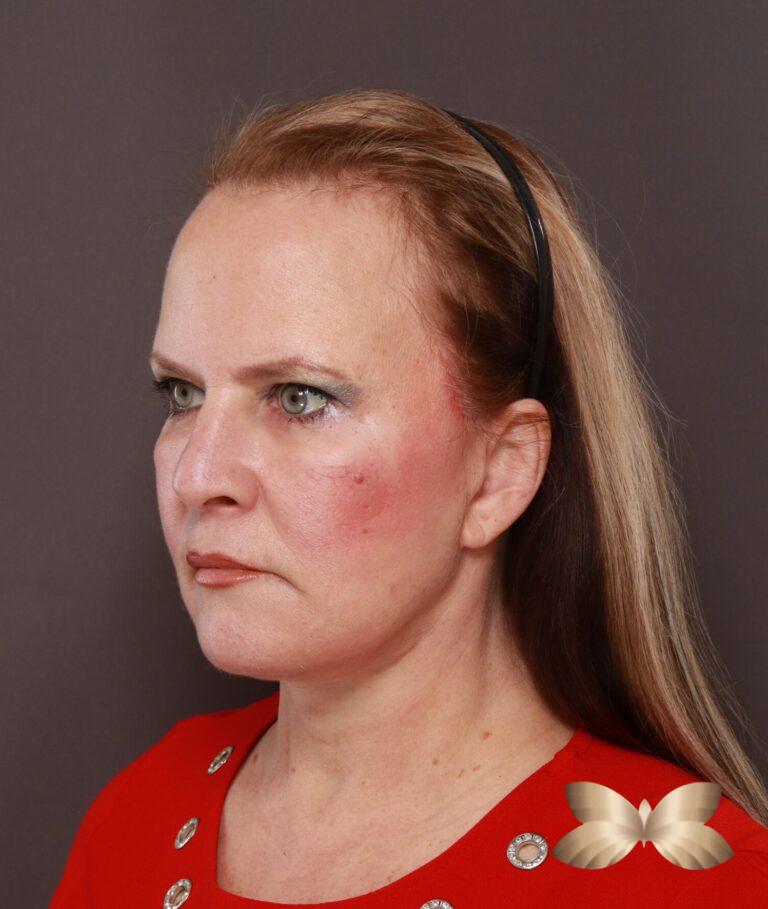 After Image: Facelift, Lower Blepharoplasty with Periorbital Fat Grafting by Dr. Thompson - left-front-oblique