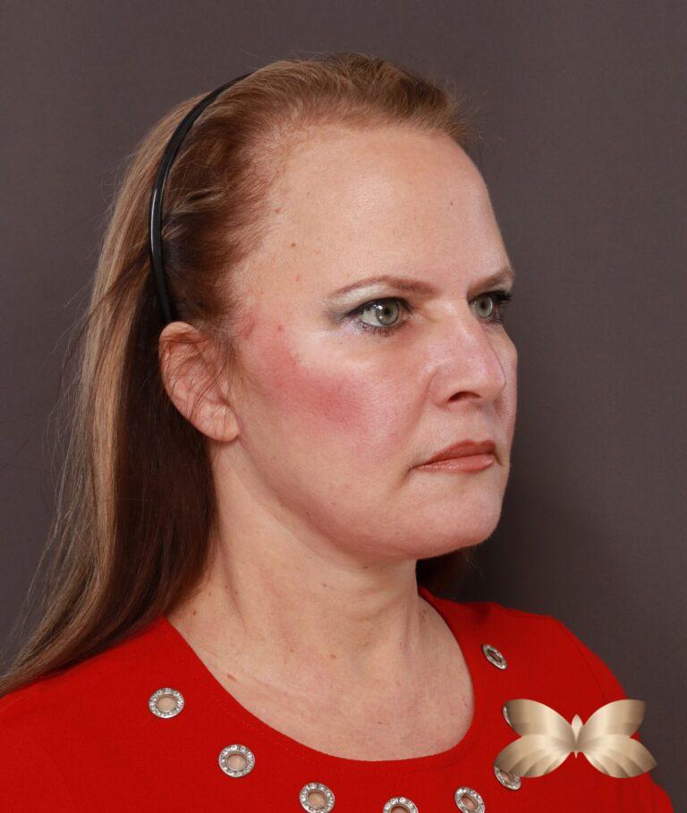 After Image: Facelift, Lower Blepharoplasty with Periorbital Fat Grafting by Dr. Thompson - right-side