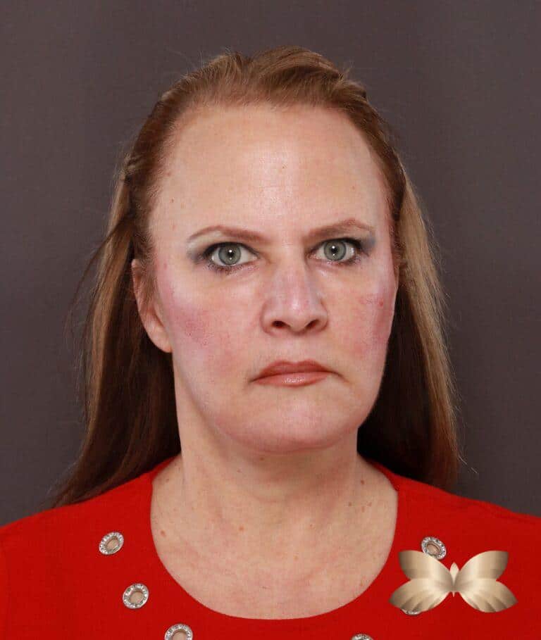 After Image: Facelift, Lower Blepharoplasty with Periorbital Fat Grafting by Dr. Thompson - front