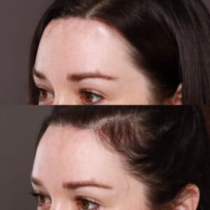 forehead reduction recovery 1