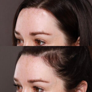 forehead reduction recovery 1 forehead reduction recovery 1