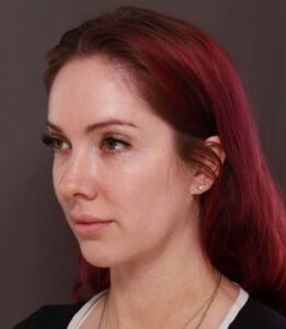 Deep Neck Contouring with Chin Implant Revision by Dr. Manning