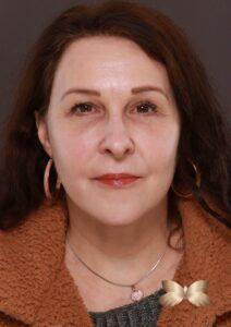 After Image: Macslift, Lower Blepharoplasty, Periorbital Fat Grafting by Dr. Henstrom