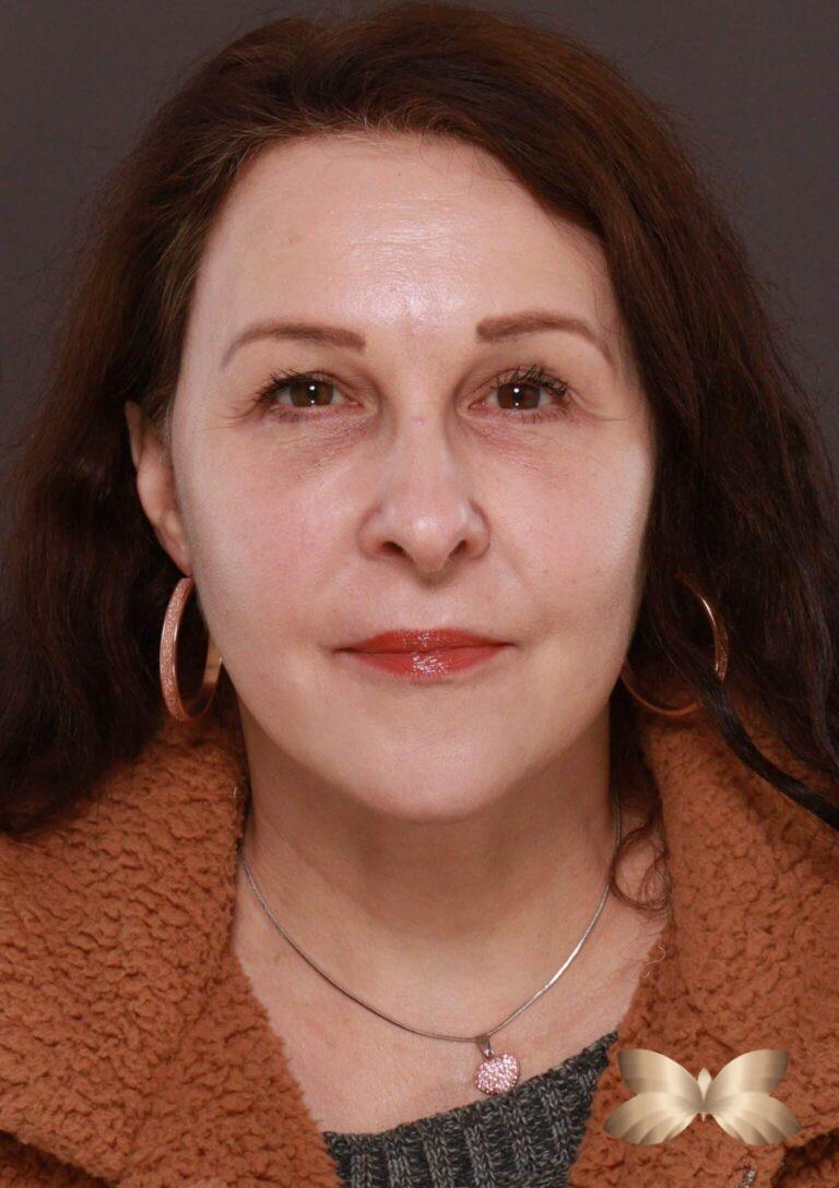 After Image: Macslift, Lower Blepharoplasty, Periorbital Fat Grafting by Dr. Henstrom - left-front-oblique