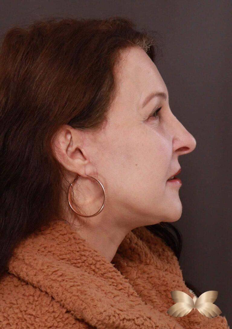 After Image: Macslift, Lower Blepharoplasty, Periorbital Fat Grafting by Dr. Henstrom - right-side