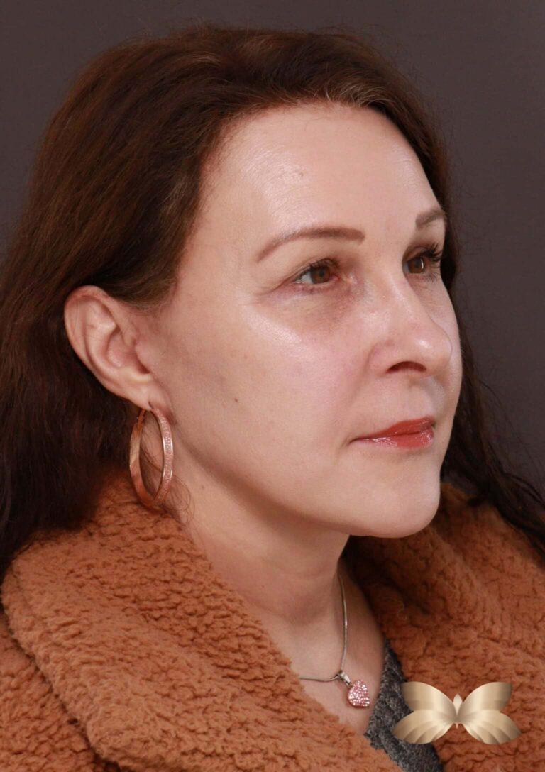 After Image: Macslift, Lower Blepharoplasty, Periorbital Fat Grafting by Dr. Henstrom -