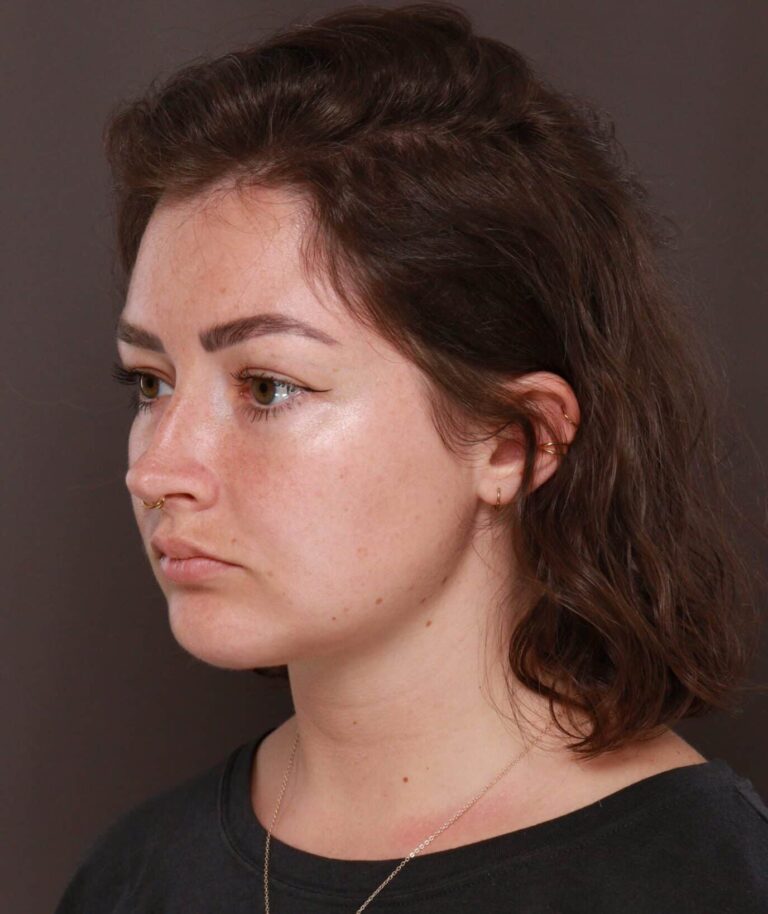 After Image: Deep Neck Contouring with Chin Implant by Dr. Manning - left-front-oblique