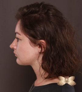 Deep Neck Contouring with Chin Implant by Dr. Manning