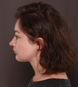 Deep Neck Contouring with Chin Implant by Dr. Manning