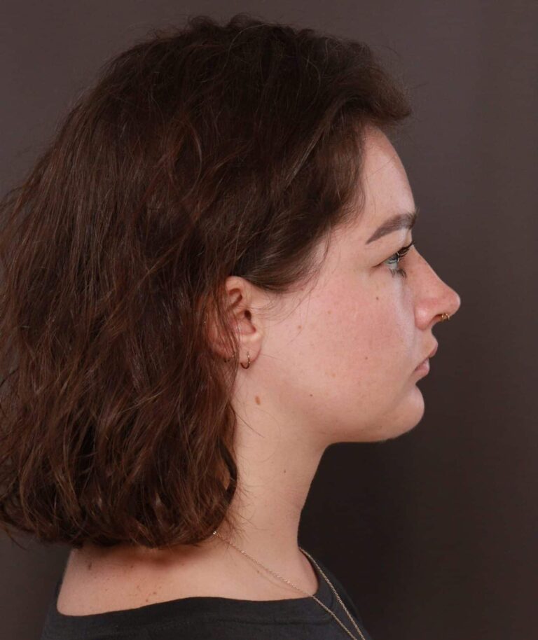 After Image: Deep Neck Contouring with Chin Implant by Dr. Manning - right-side