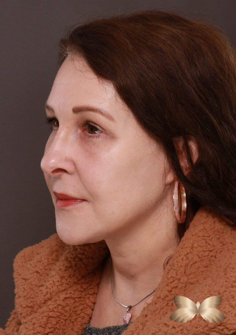 After Image: Macslift, Lower Blepharoplasty, Periorbital Fat Grafting by Dr. Henstrom -