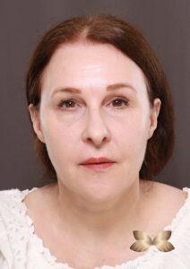 Before Image: Macslift, Lower Blepharoplasty, Periorbital Fat Grafting by Dr. Henstrom
